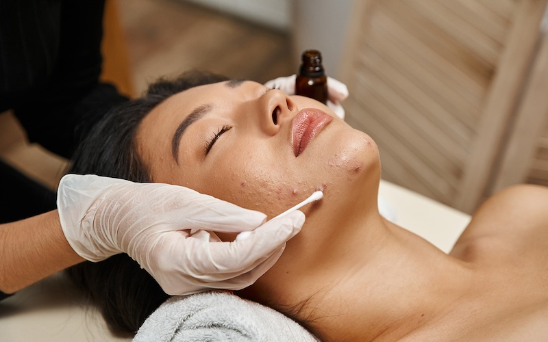 skin care treatment, therapist applying serum with cotton swab on asian woman with acne-prone skin Acne Facial treatment in Brampton, designed to target and treat acne-prone skin for clearer, healthier complexion
